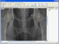Measurement of Norberg angle in dogs