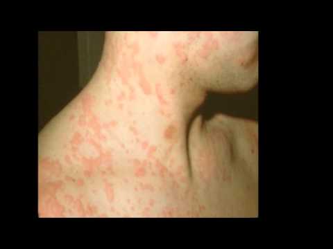 how to eliminate hives