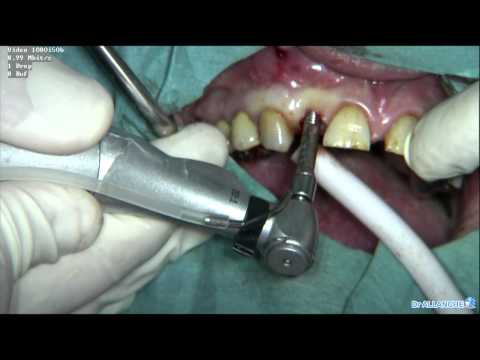 gencive - Pose d'un implant dentaire en Chirurgie mini invasive = Chirurgie Flapless Guidée. Grâce à l'acquisition d'un scanner 3D, la pose d'implants est programmée (...