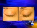 ABC Chicago #2 - Eyelash Transplants & Conditioners ABC Chicago #2 - Eyelash Transplants & Conditioners
