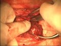 spinal surgery (plant removal) spinal surgery (plant removal)
