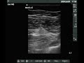 Ultrasound view of the sciatc nerve (midthigh - subgluteal)