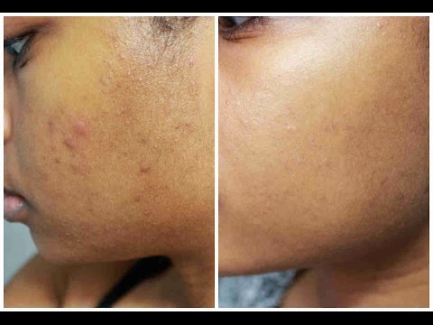 how to fade acne marks
