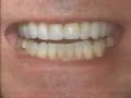 mini-dental-implants-dr-todd-shatkin-on-first-technique.html