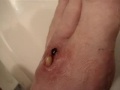 Botfly Peru