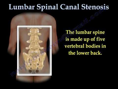 how to relieve spinal stenosis pain