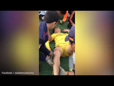 Nastawianie zwichniętej rzepki u piłkarza