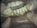 Scaling and Root Planing: Part II Mandibular Teeth