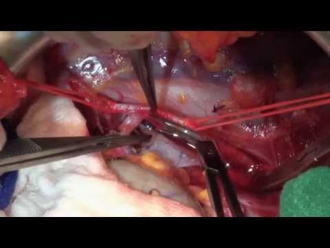 kidney - Surgical video of a pediatric kidney transplant. Performed by Dr. Pippi Salle (SickKids Hospital). © 2012, OR Media Inc.