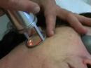 Lasering Mixto Wrinkle Treatment Lasering Mixto Wrinkle Treatment