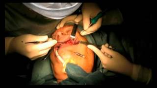 Part 3 : Greffe osseuse pré-implantaire autogène avec prélèvement crânien avant implants dentaires 
