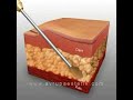 Karından Liposuction ile Yağ Aldırma Videosu, Op.Dr. Nazmi Bayçın