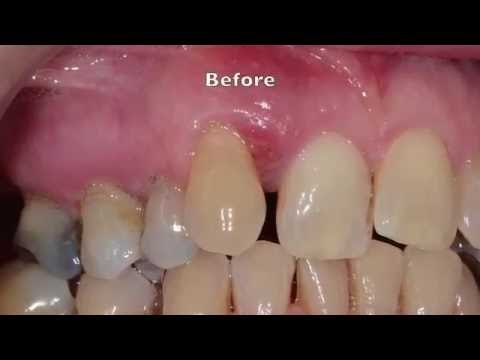 how to treat gum disease in dogs