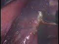 cholecystectomy Cholecystectomy