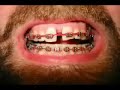 orthodontic brace: power chain!