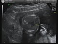 Baby Midkiff 1 of 5