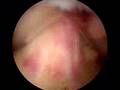 Patellar Tendon Surgery 3