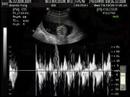 Jolyn Ultrasound Film Jolyn Ultrasound Film