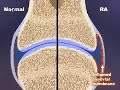 RA