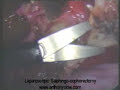 Laparoscopic Removal of Ovary