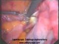 Laparoscopic Removal of Ovary