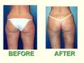 Dr. Larry Weinstein reviews LIPOSUCTION