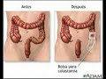 Limpieza Intestinal Profunda FLP