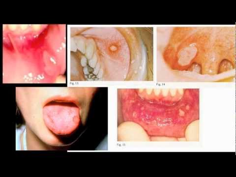 how to treat aphthous ulcers