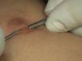 Matts nipple piercing