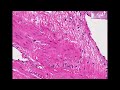Histopathology Uterus --Leiomyosarcoma Histopathology Uterus --Leiomyosarcoma