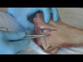 Suture - Basic Technique 1