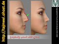 Rhinoplasty (ARABIC)  د. محمد الروبى تجميل الأنف