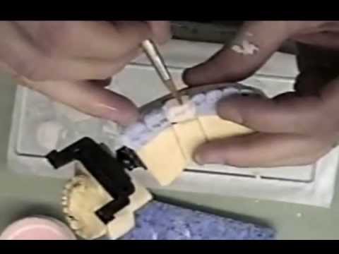 how to repair pfm crown
