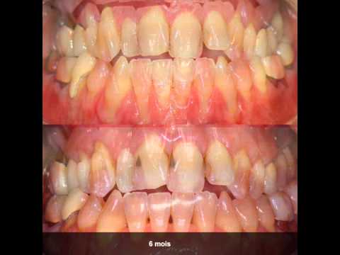 gencive - Traitement des récessions gingivales par auto-greffe conjonctive enfouie, technique de la tunnellisation.