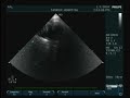 ECG-VIDEO Fallot's Tetralogy