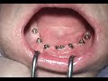 Bionic Teeth
