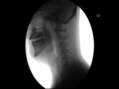 how to get xray on vine