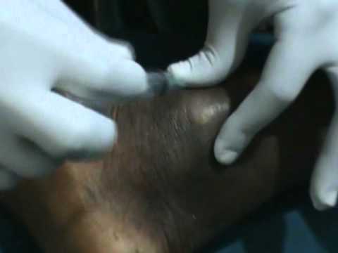 how to self diagnose an ulcer