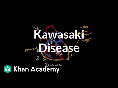 how to cure kawasaki disease