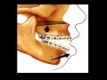 Upper and Lower Jaw Surgery in 2 Years!