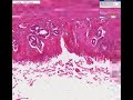 Histopathology Stomach--Erosion Histopathology Stomach--Erosion