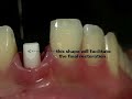 CeraRoot Zirconia Dental Implant Surgery (central Incisor)
