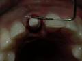 CeraRoot Zirconia Dental Implant Surgery (central Incisor)