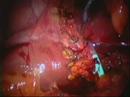 Endoprotesis transpapilar coledocolitiasis laparoscopica Endoprotesis transpapilar coledocolitiasis laparoscopica