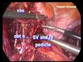 laparoscopic Radical Cystectomy
