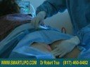 Inner Thighs Liposuction  Dr. True  www.SmartLipo.com
