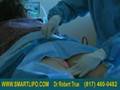 videos de Inner Thighs Liposuction  Dr. True  www.SmartLipo.com 2