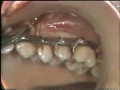 Segmental Maxillary Osteotomy