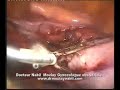 laparoscopic supracervical hysterectomy
