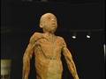 Cadaver Controversy